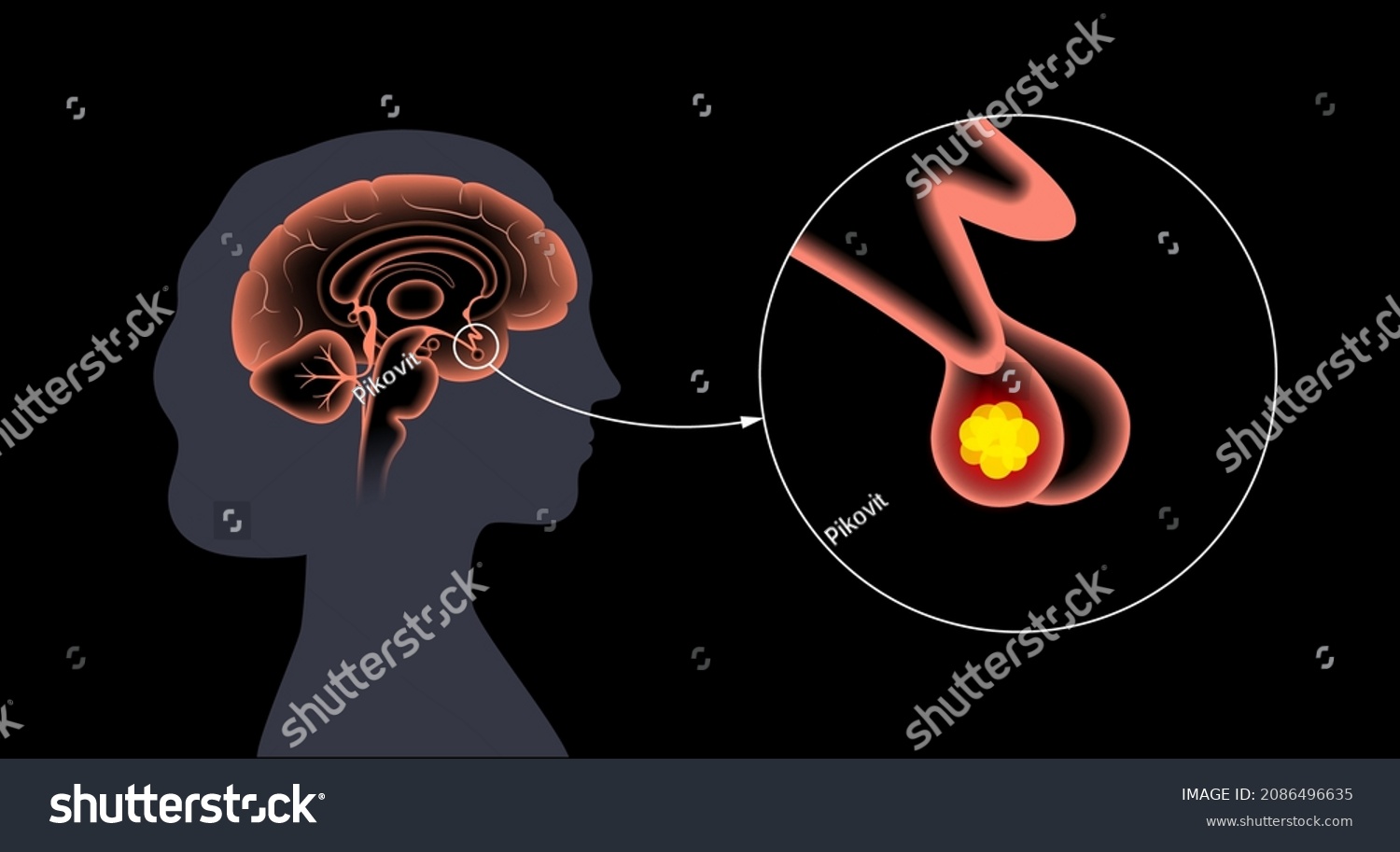 Pituitary Adenoma Concept Tumor Human Brain Stock Vector Royalty Free 2086496635 Shutterstock 0806