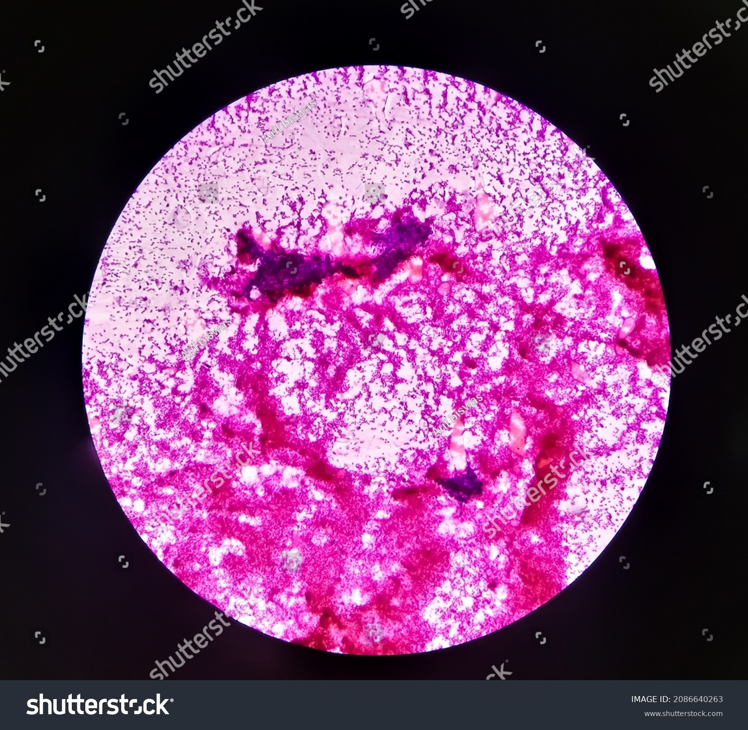 Pleomorphic Adenoma Left Parotid Swelling Fna Stock Photo 2086640263 ...