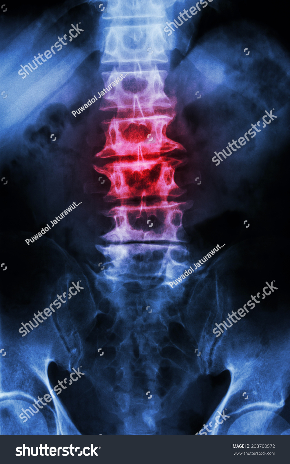 Spondylosis Film Xray Ls Spine Lumbarsacrum Stock Photo 208700572 ...