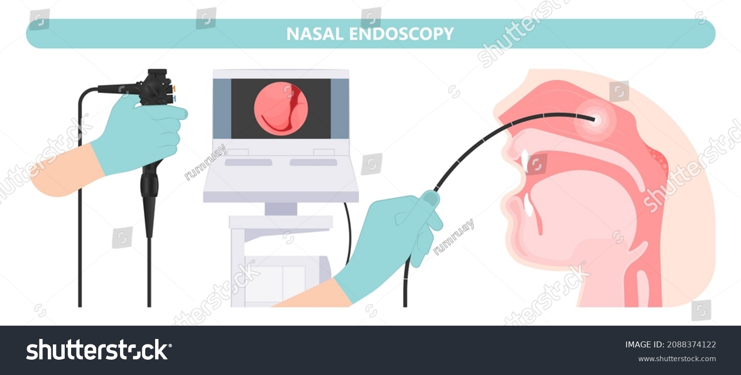 Nasal Endoscopy Throat Back Voice Box Stock Vector (Royalty Free