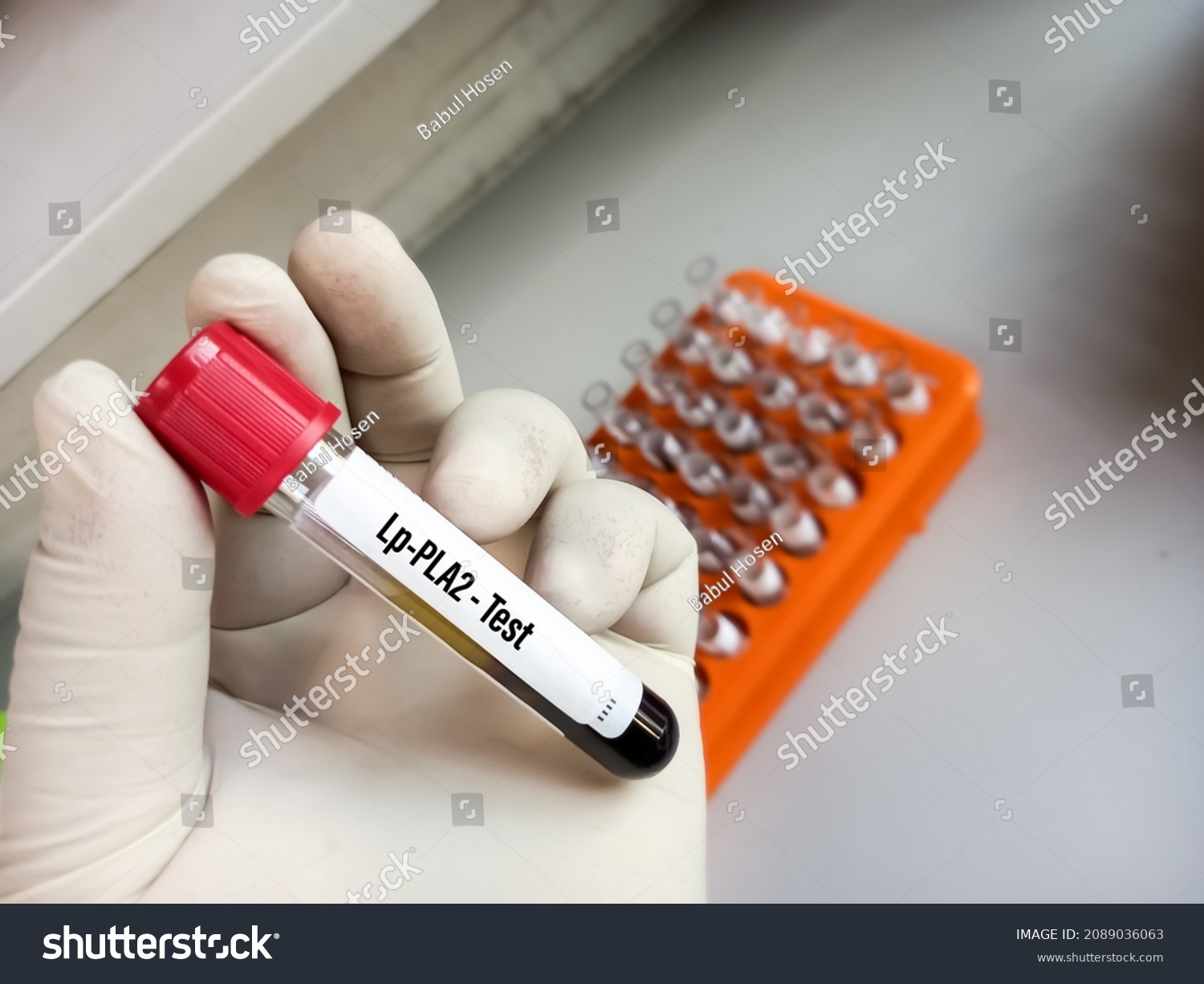 4 Lipoprotein Associated Phospholipase A2 Images, Stock Photos ...