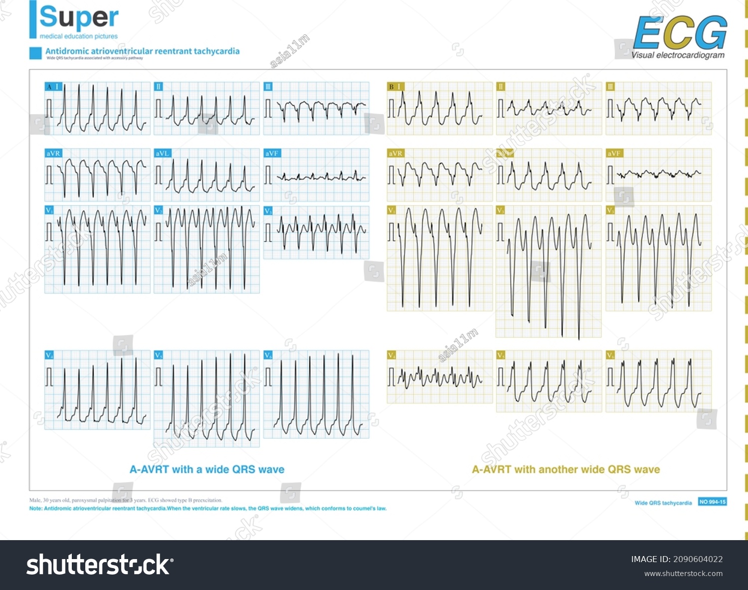 Patients Basic Ecg Showed Type B Stock Illustration 2090604022 ...