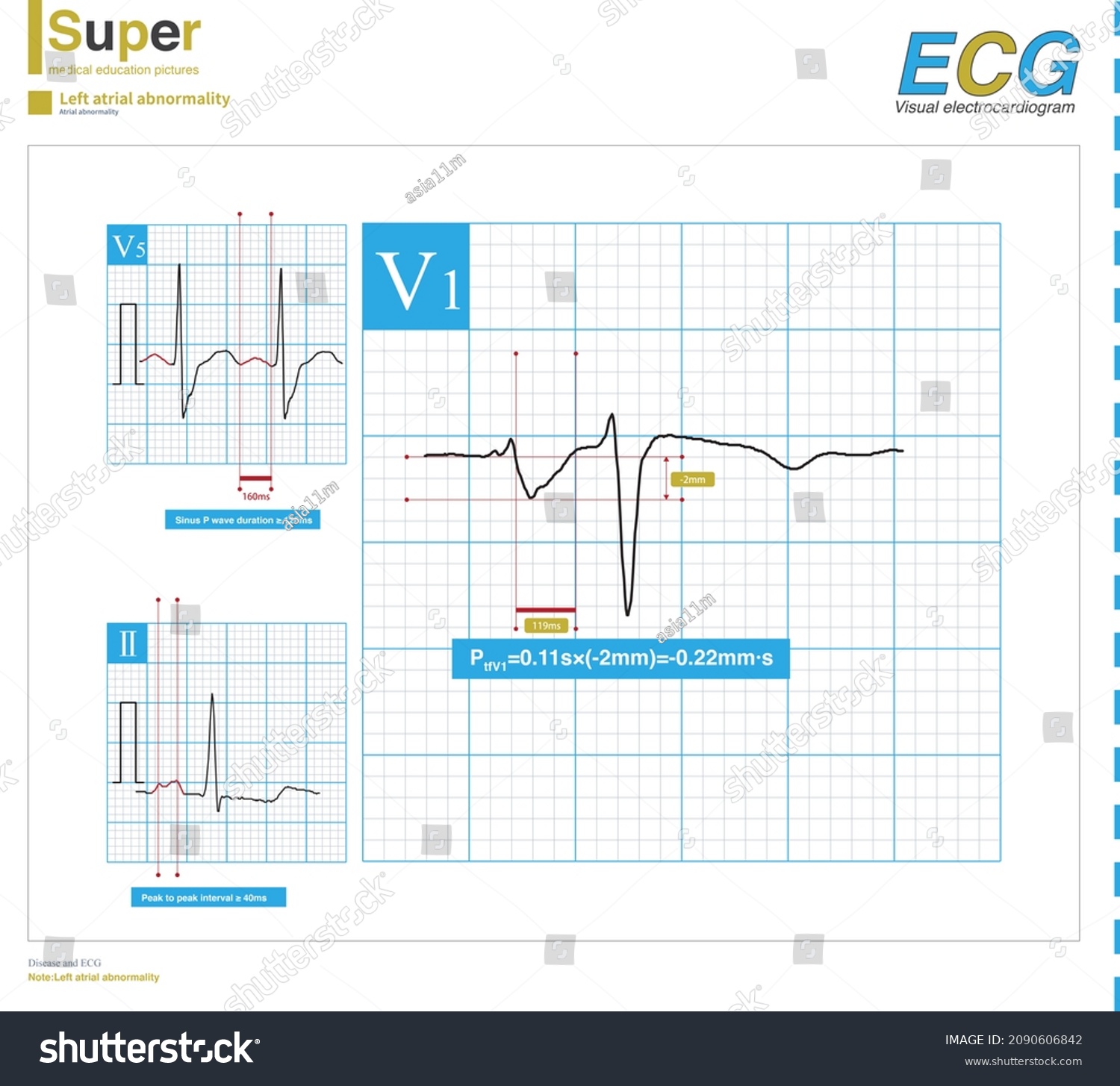 When Ecg Used Diagnose Left Atrial Stock Illustration 2090606842 ...