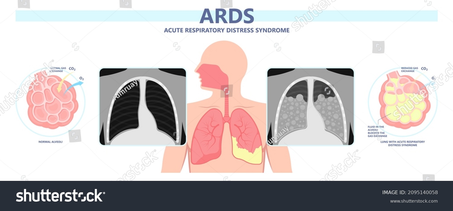Acute Respiratory Distress Syndrome Ards Respiratory Stock Vector Royalty Free