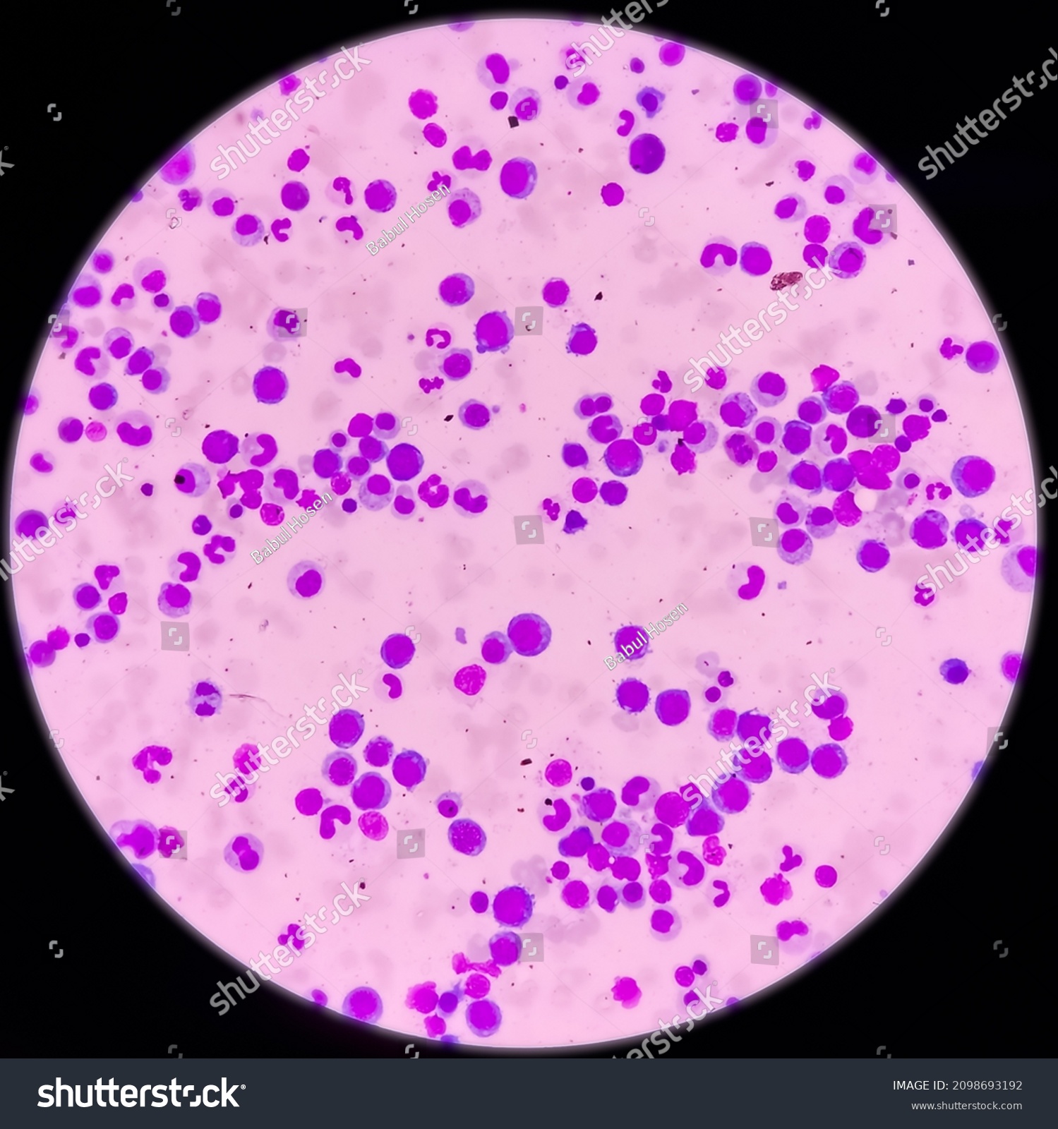 Microscopic View Bone Marrow Slide Megaloblastic Stock Photo 2098693192 ...