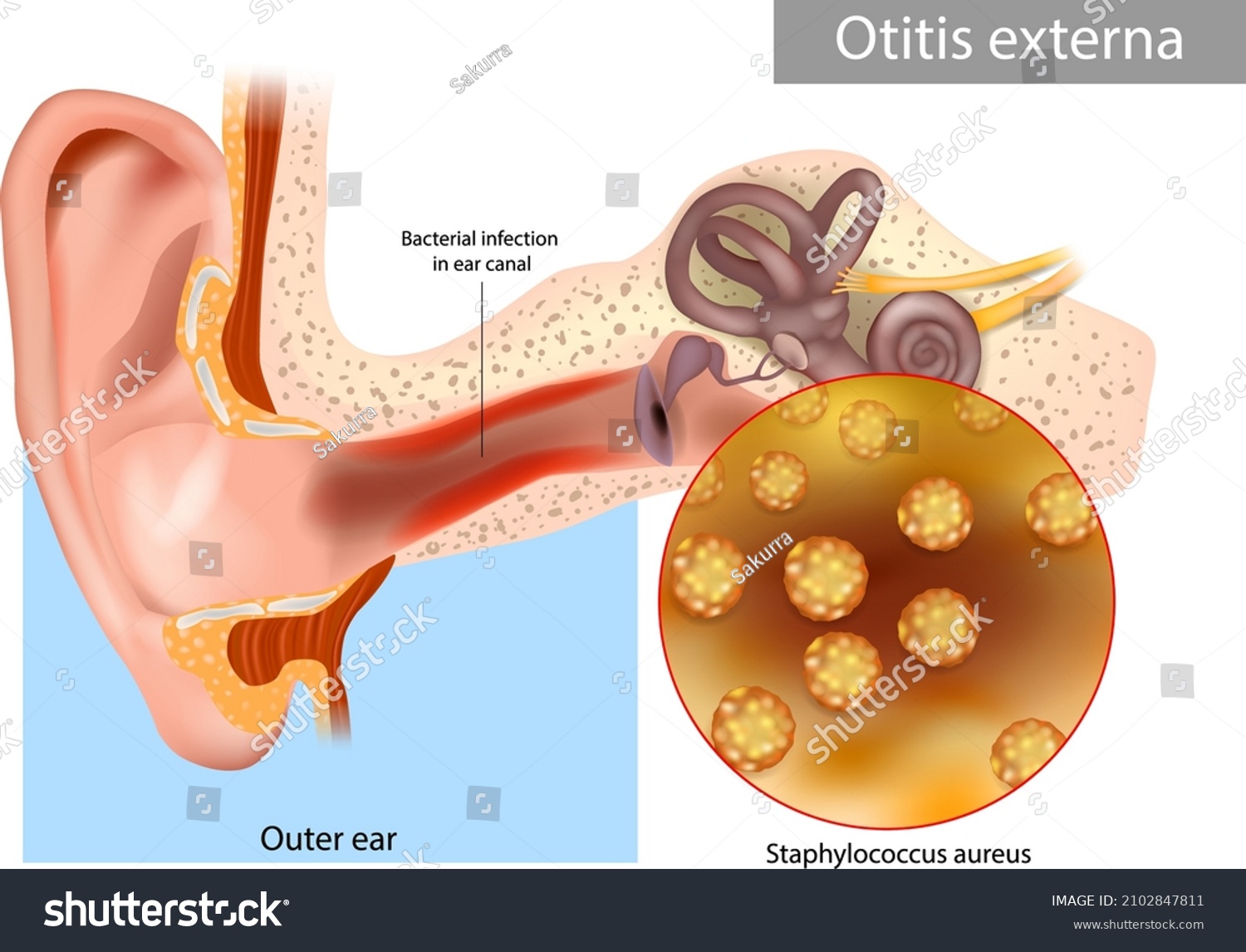 Otitis Externa Called Swimmers Ear Inflammation Stock Vector Royalty Free