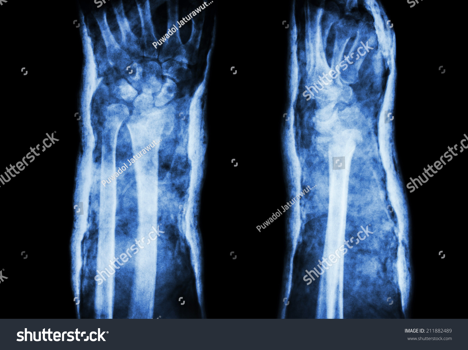 Fracture Distal Radius Colles Fracture Cast Stock Photo 211882489 ...