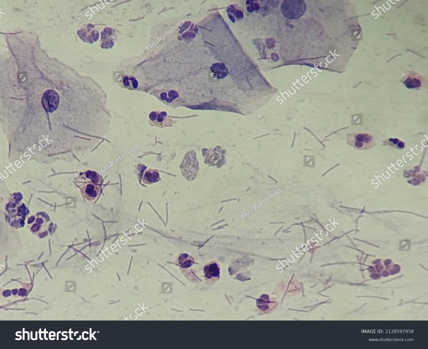 Fungi Infection Pap Smear Cervix Stock Photo 2128597958 Shutterstock fungi-infection-pap-smear-cervix-stock-photo-2128597958-shutterstock