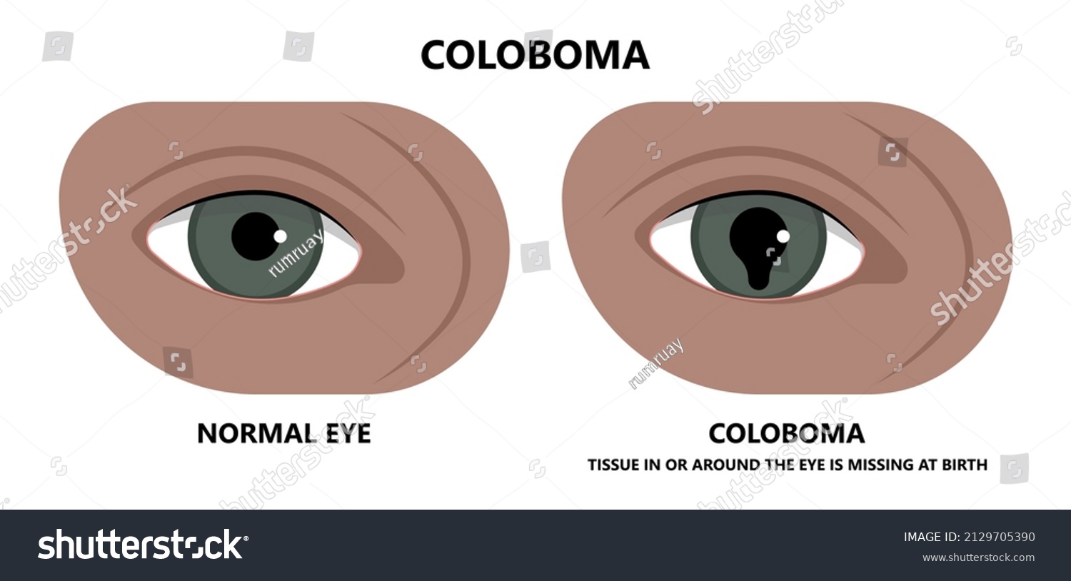 coloboma of the eye