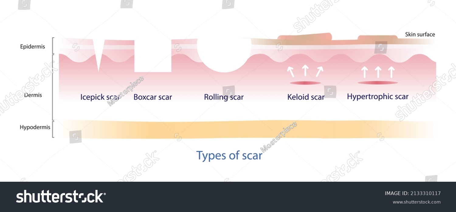 Types Scar Vector Icepick Boxcar Rolling Stock Vector (royalty Free 