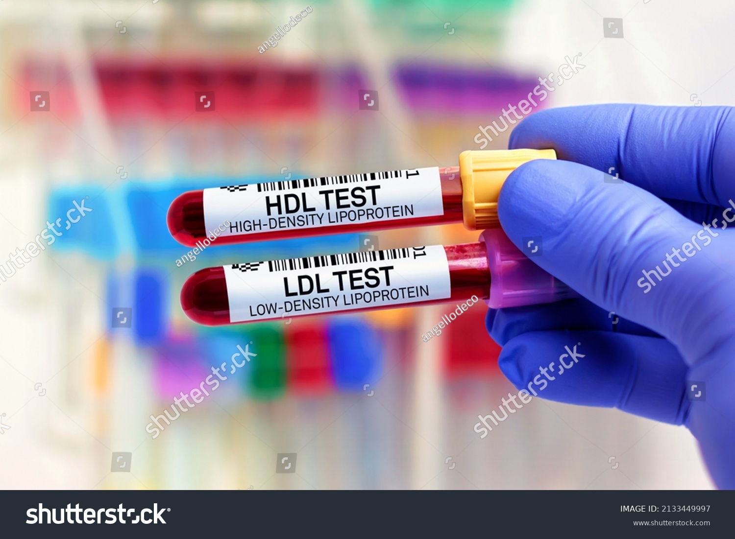 blood-samples-patient-high-density-lipoprotein-stock-photo-2133449997