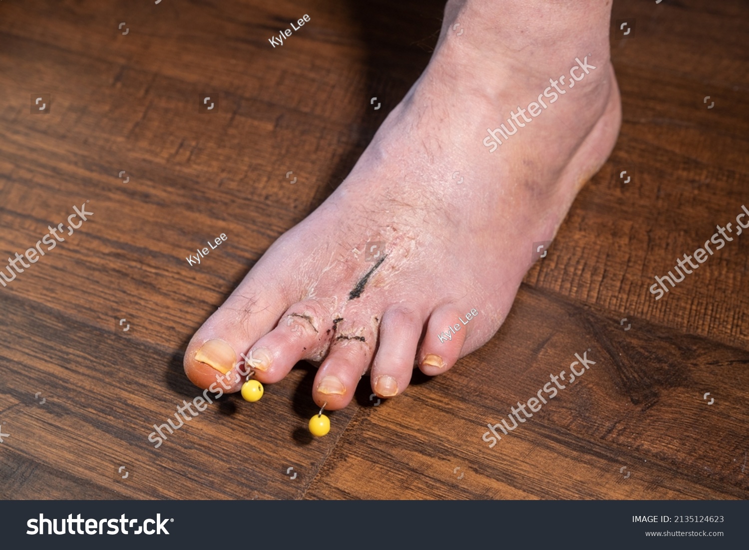 hammer toe in with pin