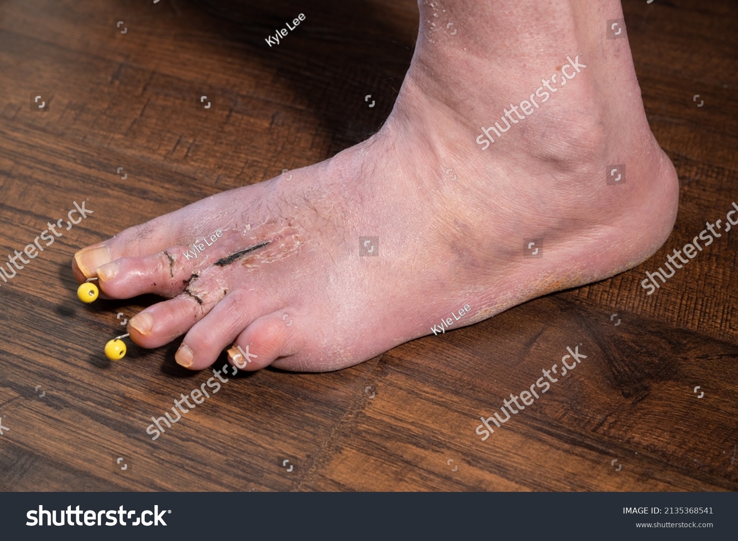 hammer toe in with pin