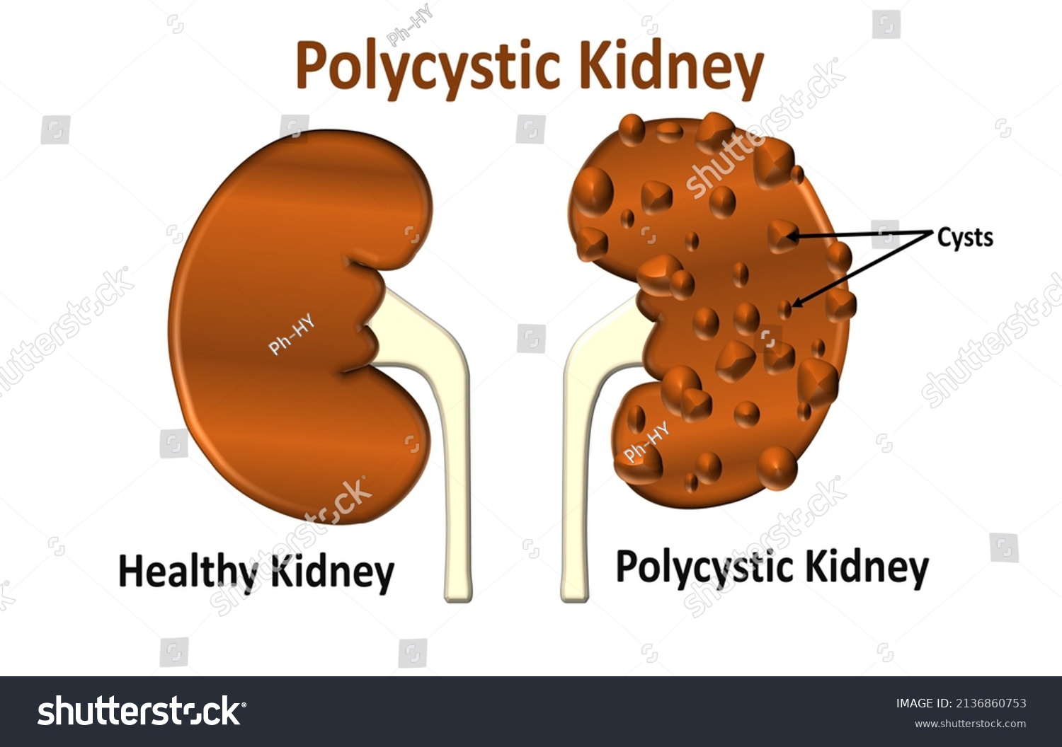 Polycystic Kidney Disease Illustration Renal Cysts Stock Vector ...