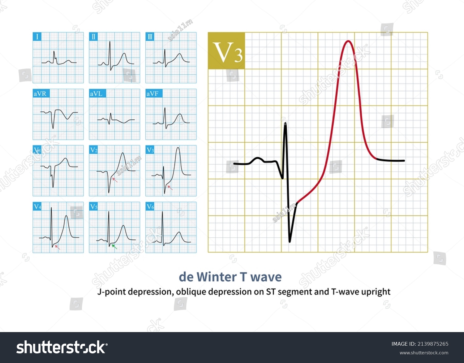 Male 69 Years Old Chest Pain Stock Illustration 2139875265 