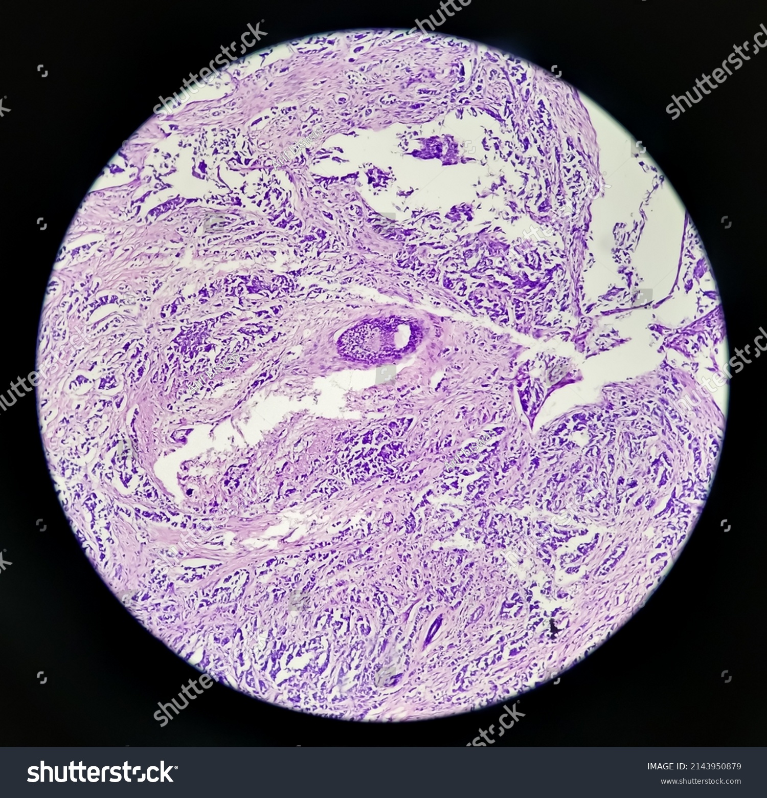 Calcinosis Cutis Histology Image Analyzed By Stock Photo 2143950879 ...