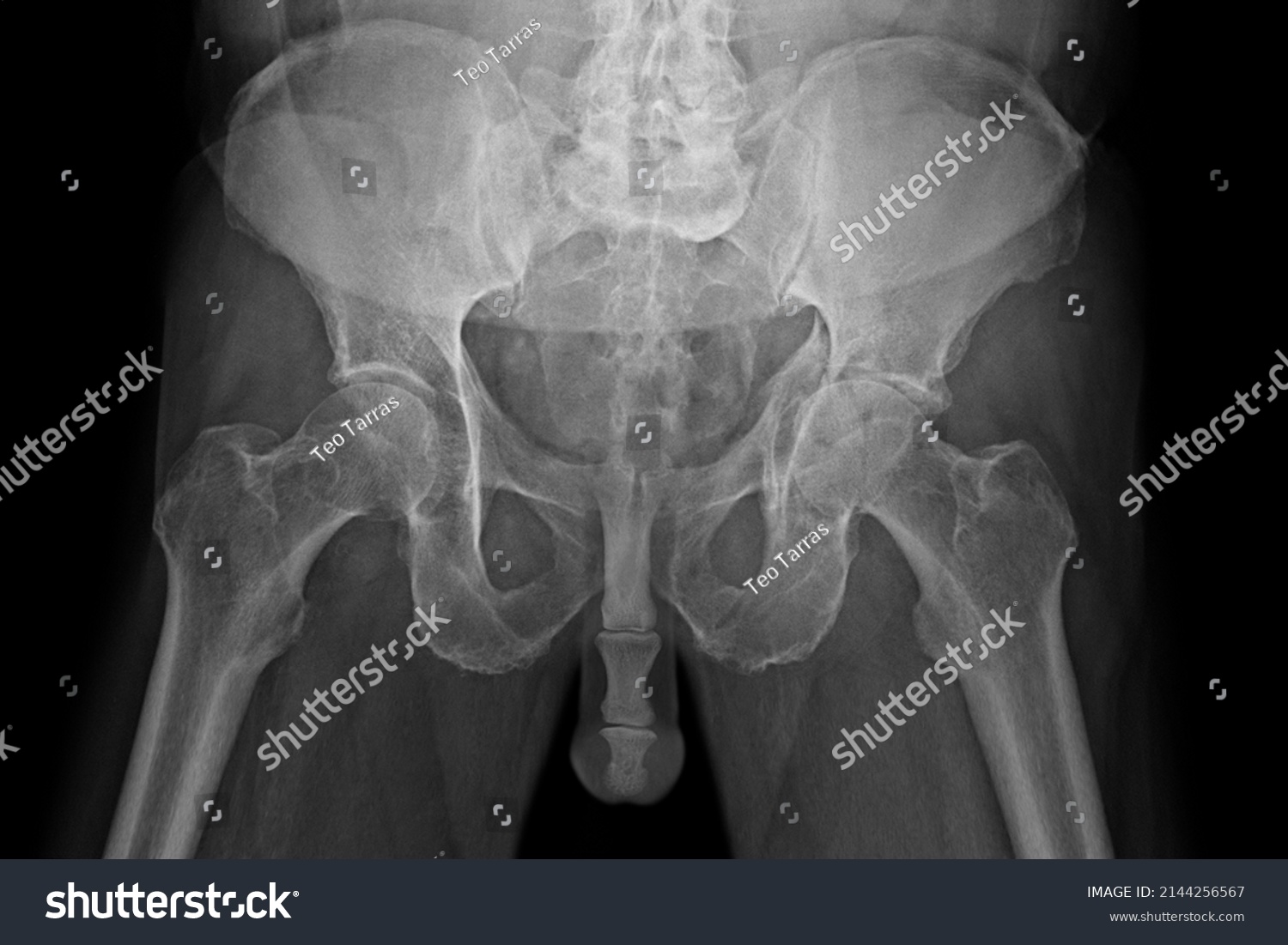 Xray Pelvis Penis Stock Photo Shutterstock