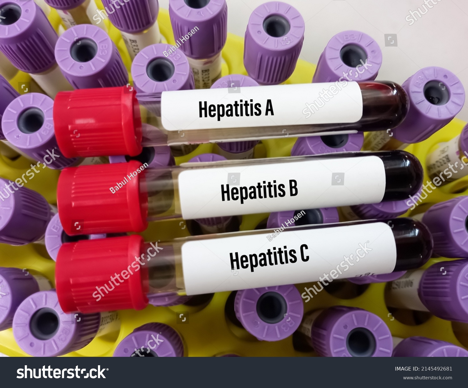 Blood Samples Tube Sample Hepatitis Virus Stock Photo 2145492681 ...