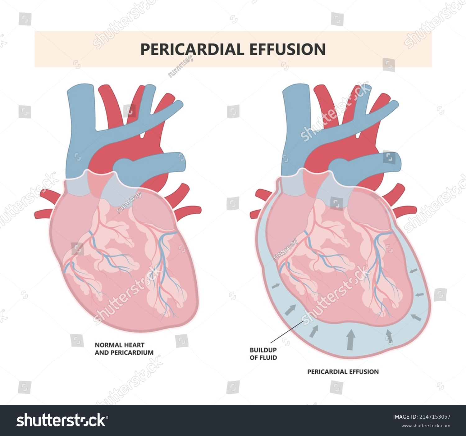 Heart Attack Acute Chest Pain Injury Stock Vector (Royalty Free ...