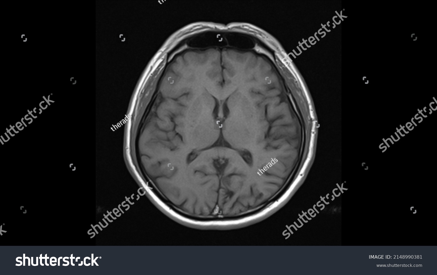 Normal Brain Anatomy Axial T1weighted Mri Stock Photo 2148990381 ...