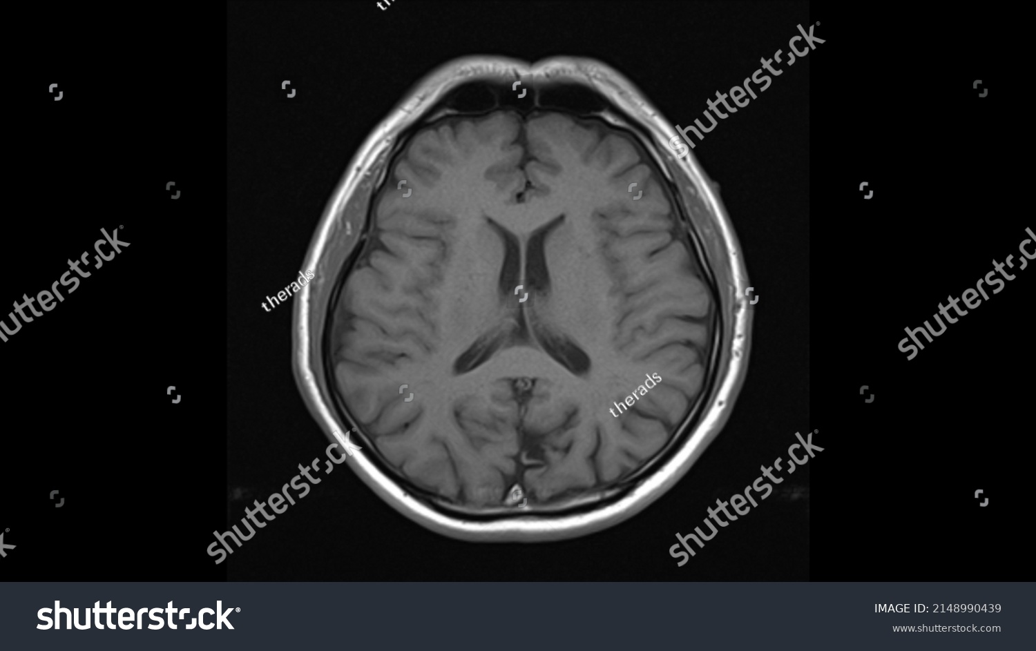 Normal Brain Anatomy Axial T1weighted Mri Stock Photo 2148990439 ...