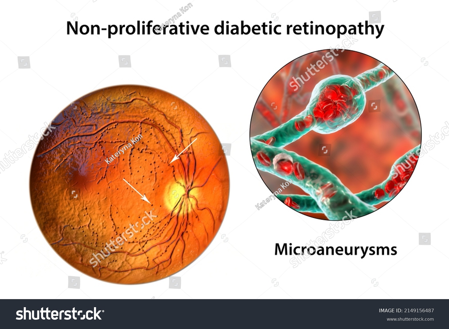 Nonproliferative Diabetic Retinopathy 3d Illustration Showing Stock