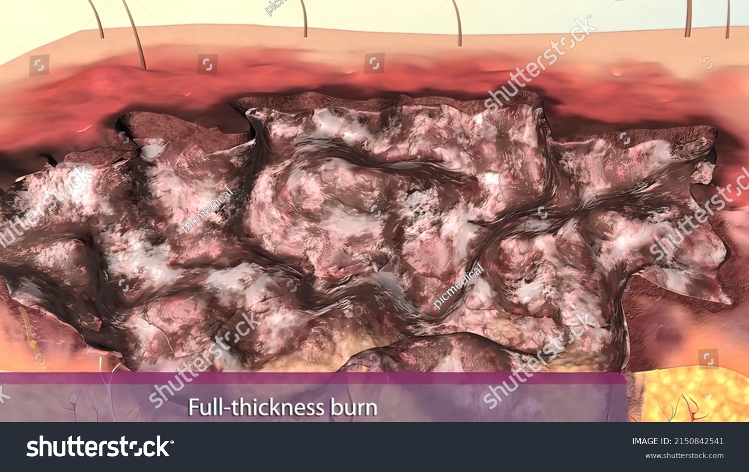 Full Thickness Burns Third Degree Burns Stock Illustration 2150842541 Shutterstock 0947