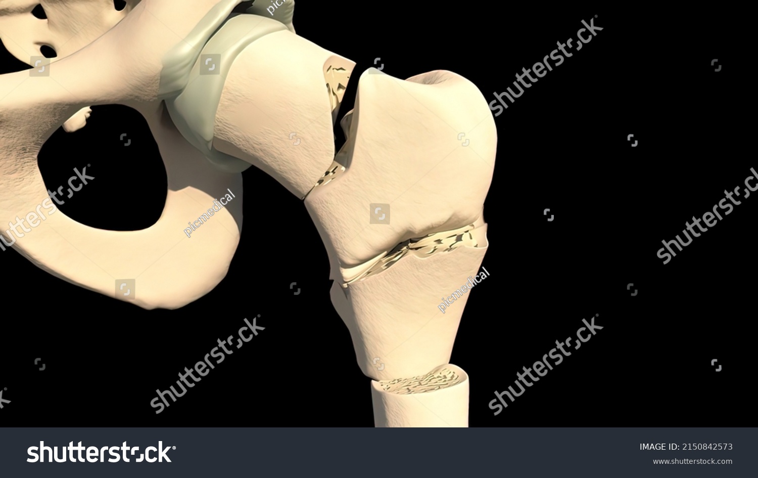 Femur Fracture Break Crack Crush Injury Stock Illustration 2150842573 ...