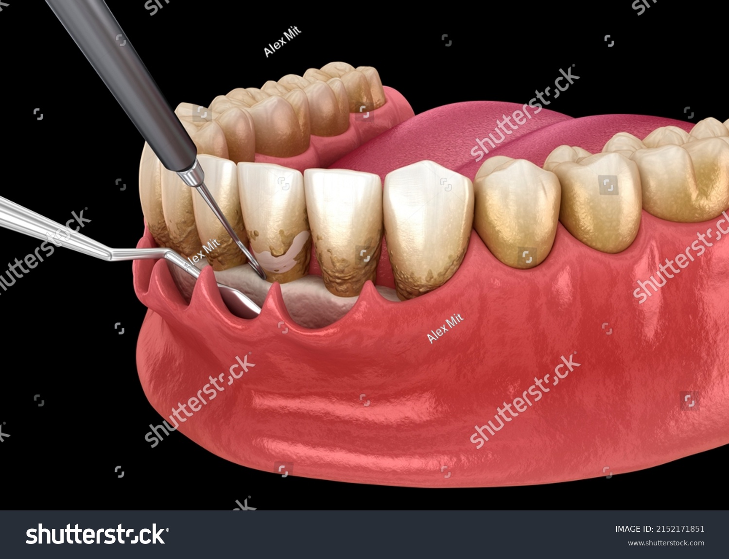 Open Curettage Scaling Root Planing Conventional Stock Illustration 2152171851 Shutterstock 5651