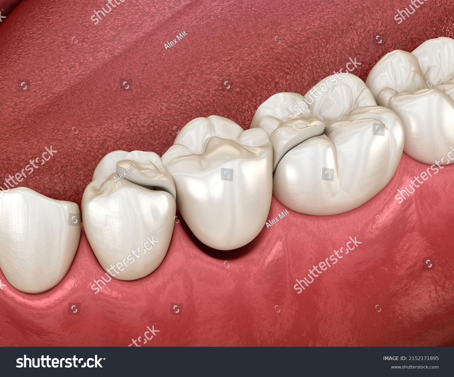 Maryland Bridge Made Ceramic Premolar Tooth Shutterstock