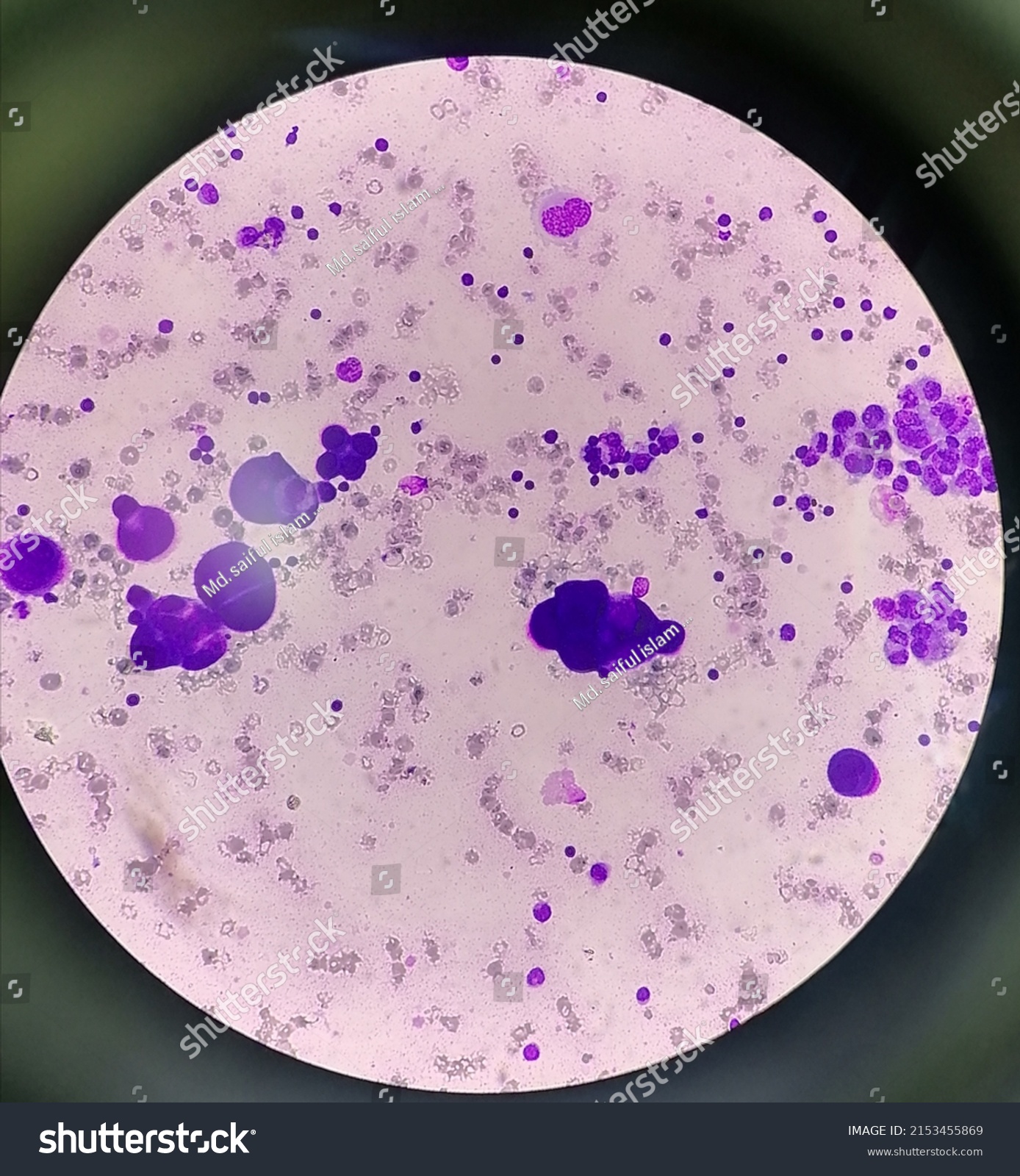 Acitic Fluid Cytology Malignant Positive Cell Stock Photo 2153455869 ...