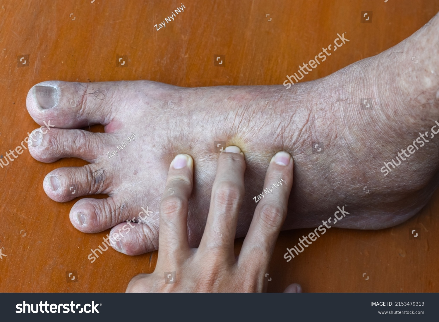 Pitting Edema Lower Limb Swollen Foot ภาพสต็อก 2153479313 Shutterstock