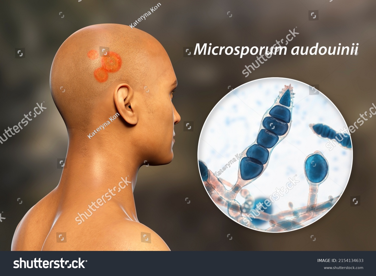 Fungal Infection On Mans Head 3d Stock Illustration 2154134633 Shutterstock 