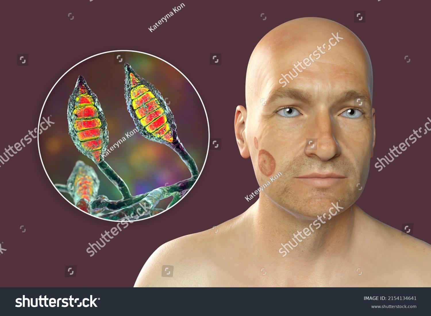 Fungal Infection On Mans Face 3d Stock Illustration 2154134641 Shutterstock 