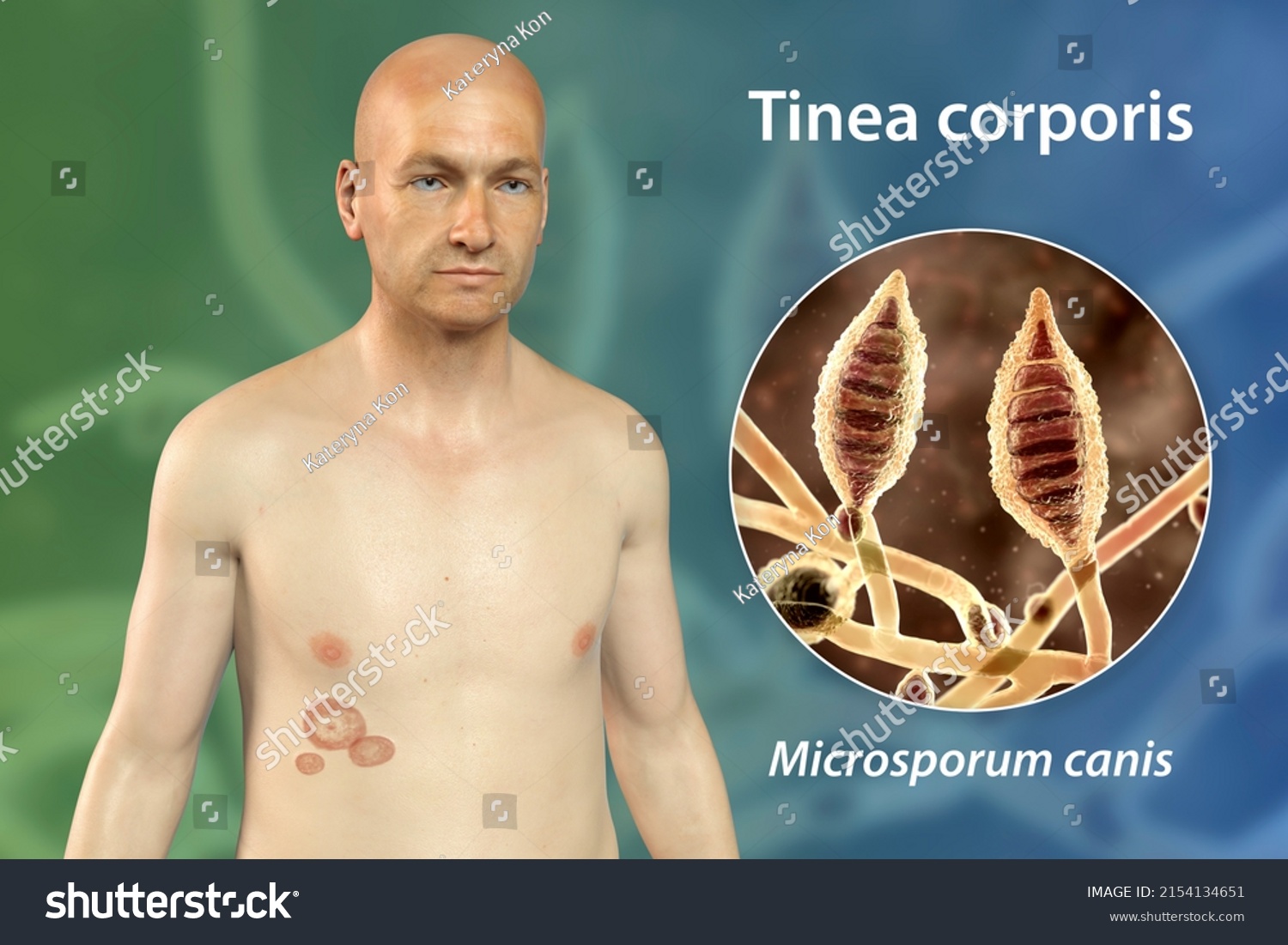 Fungal Infection On Mans Body Tinea Stock Illustration 2154134651 Shutterstock 