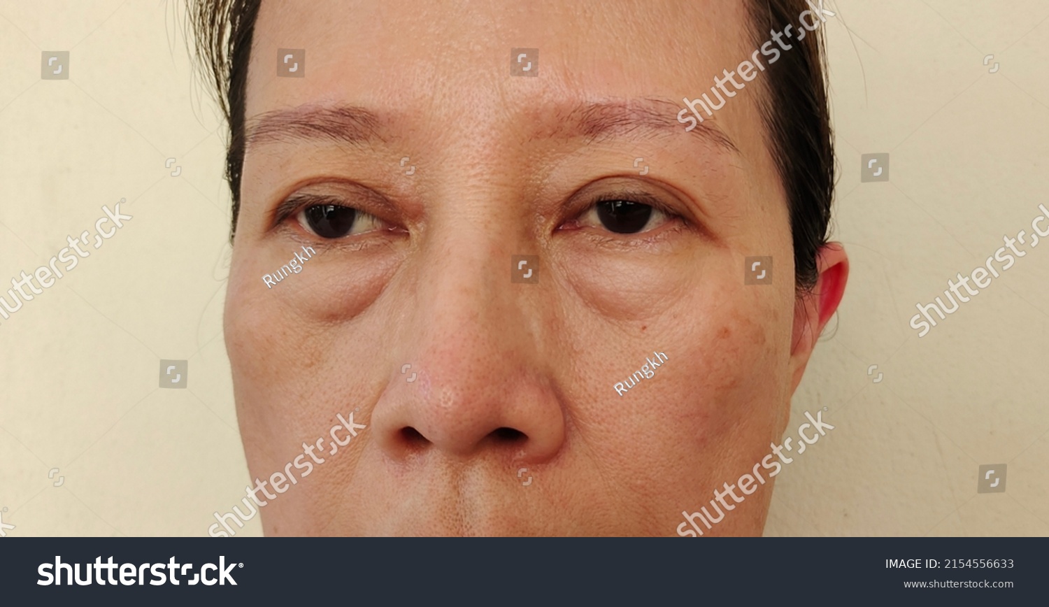 Portrait Showing Flabbiness Adipose Blemishes On Stock Photo 2154556633 ...