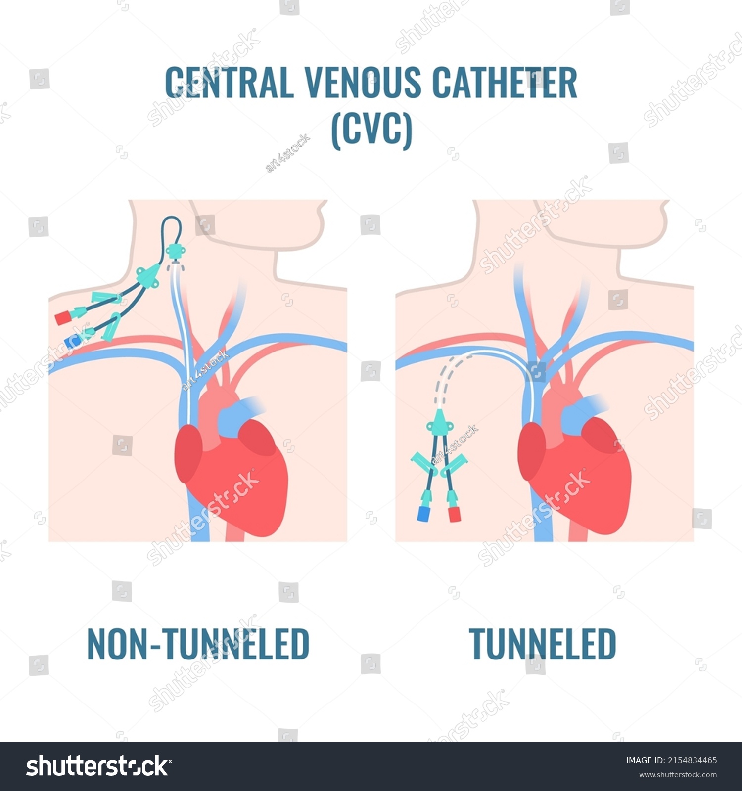 Tunneled Nontunneled Central Venous Catheters Placed Stock Vector Royalty Free 2154834465 0317