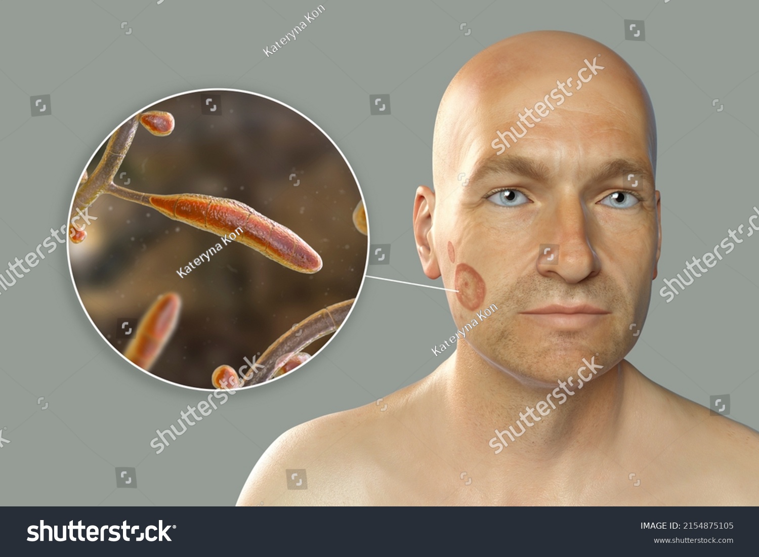 Fungal Infection On Mans Face 3d Stock Illustration 2154875105 Shutterstock 