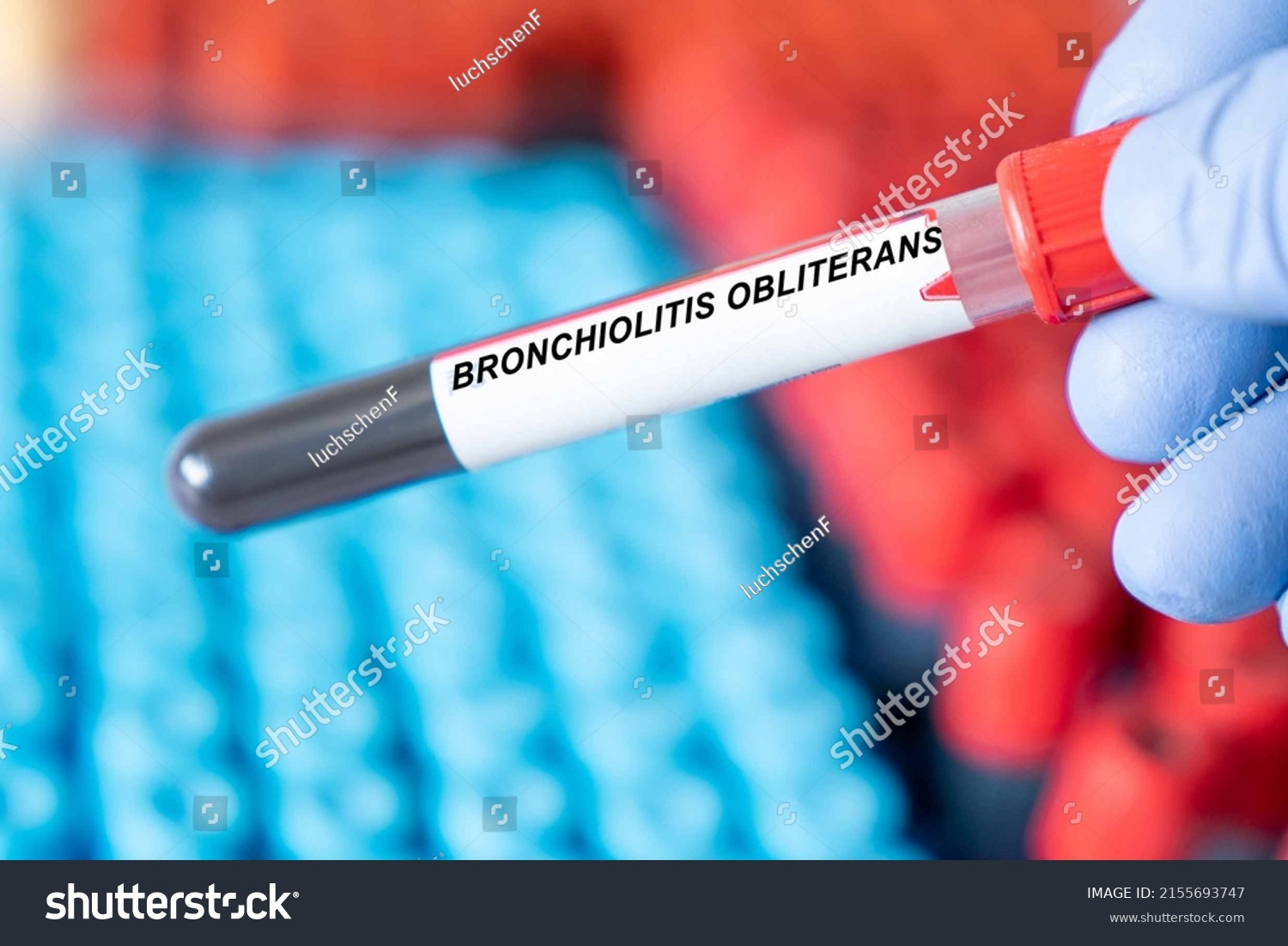 bronchiolitis-obliterans-bronchiolitis-obliterans-disease-blood-stock