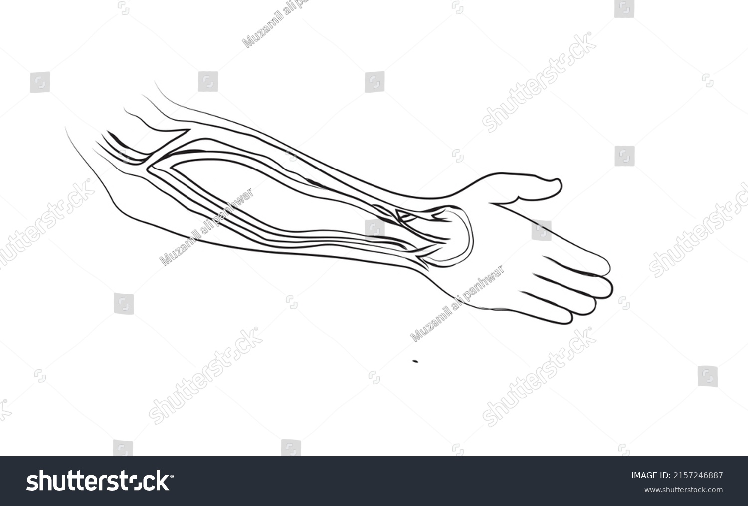 Illustration Arteriovenous Fistula an Arteriovenous Av Stock Vector ...