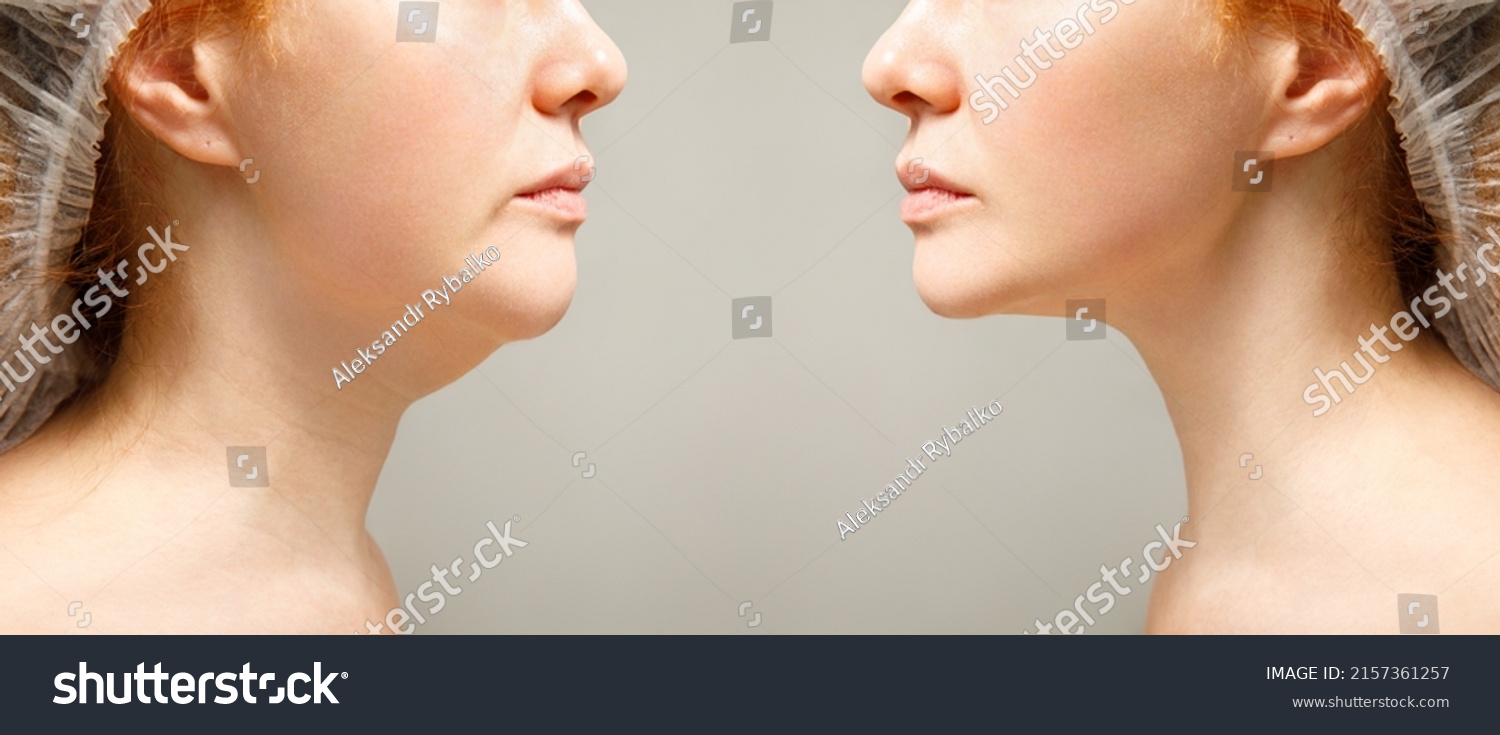 Female Double Chin Before After Correction Stock Photo 2157361257 ...