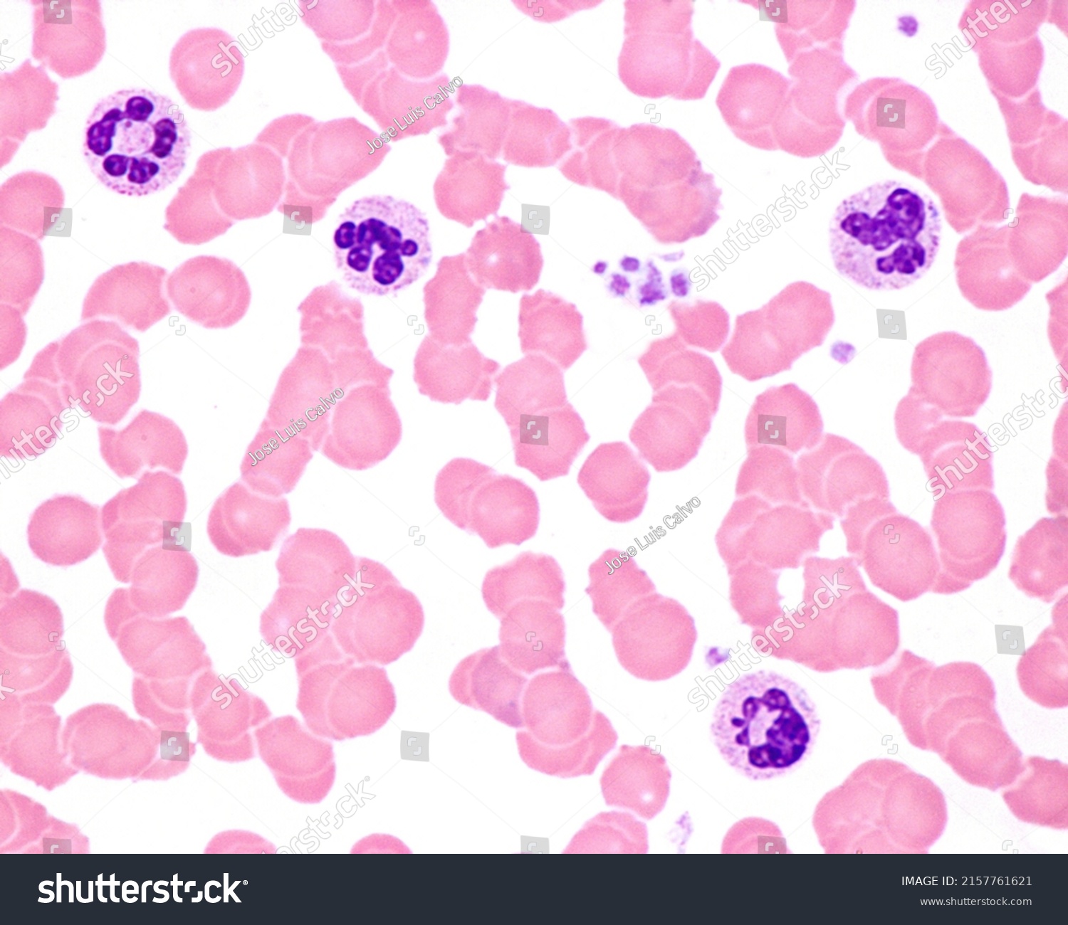 Human Blood Smear Leukocytosis Acute Infection ภาพสต็อก 2157761621 