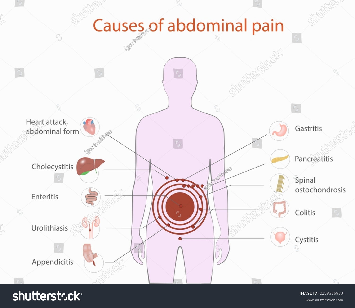 Causes Abdominal Pain Vector Medical Diagram Stock Vector (Royalty Free ...