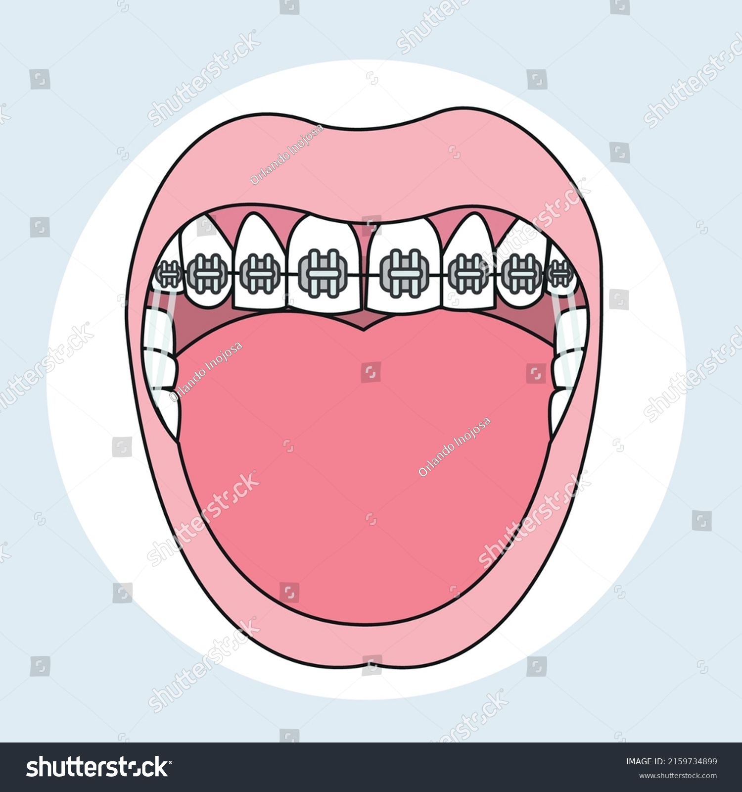 Traditional Metal Braces Orthodontist Vector Illustrator Stock Vector ...