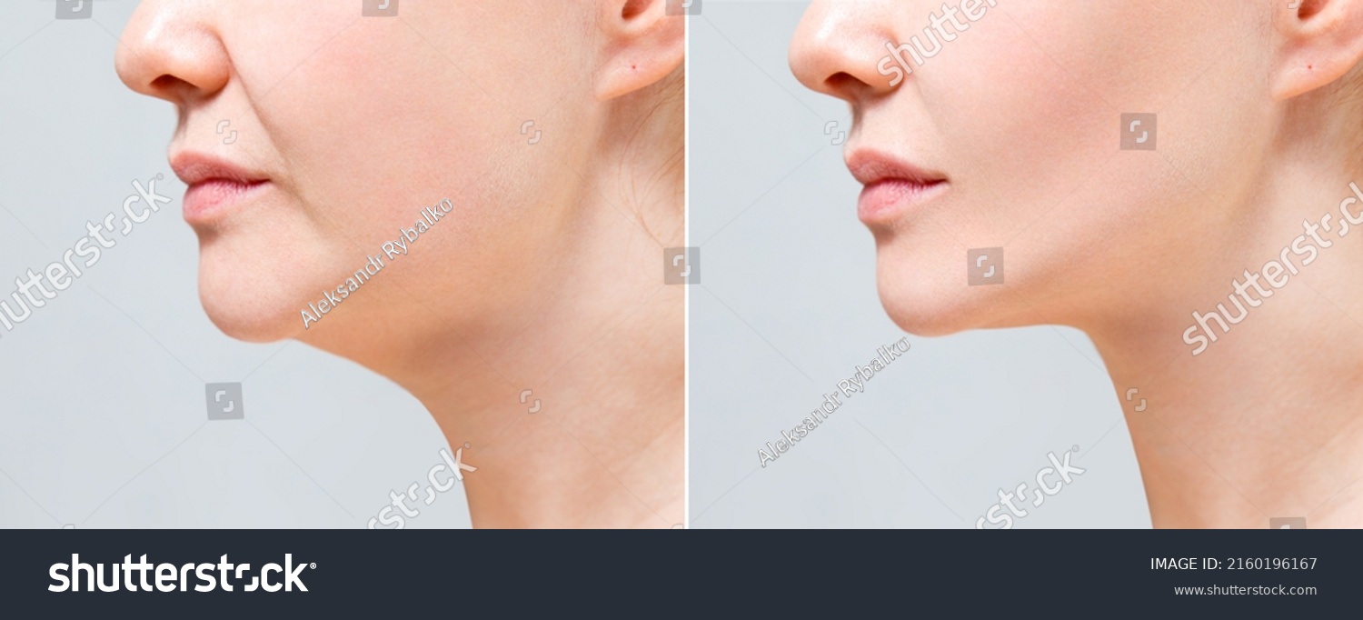 Female Double Chin Before After Correction Stock Photo 2160196167 ...