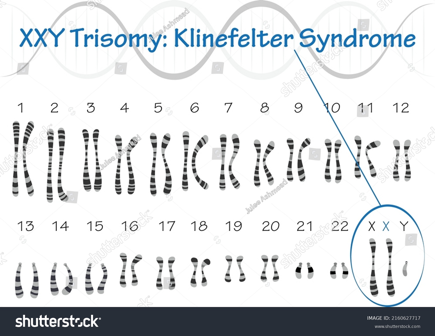 Klinefelter Syndrome Karyotype Human Chromosomes Stock Vector (Royalty ...