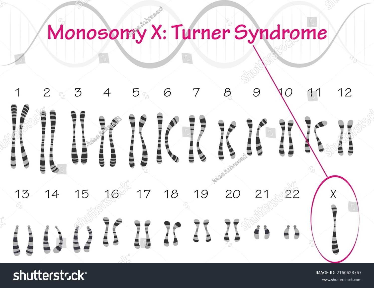 Monosomy X Turner Syndrome Karyotype Stock Vector (Royalty Free ...