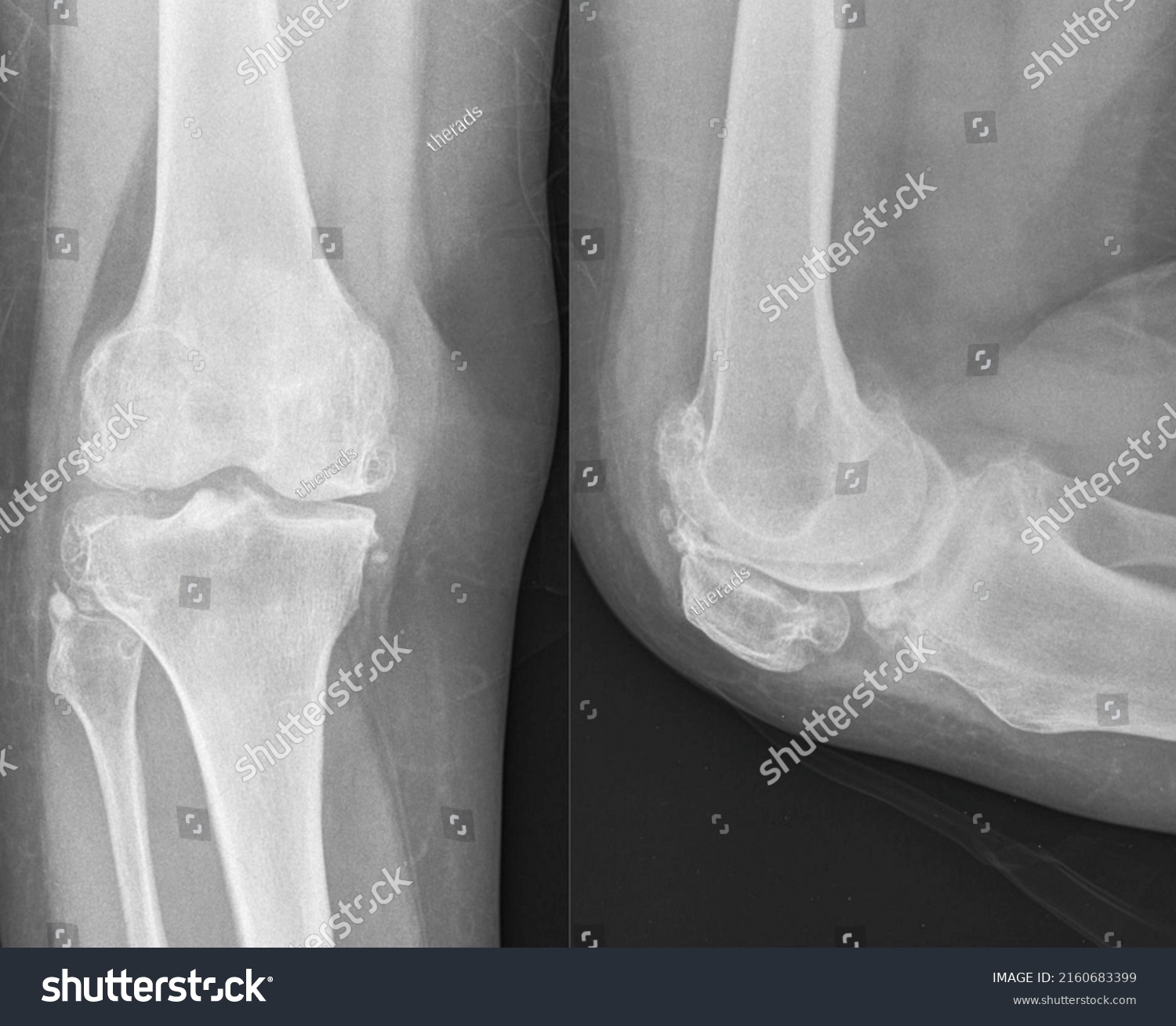 Osteoarthritis Knee Show Narrow Joint Space Stock Photo 2160683399 ...