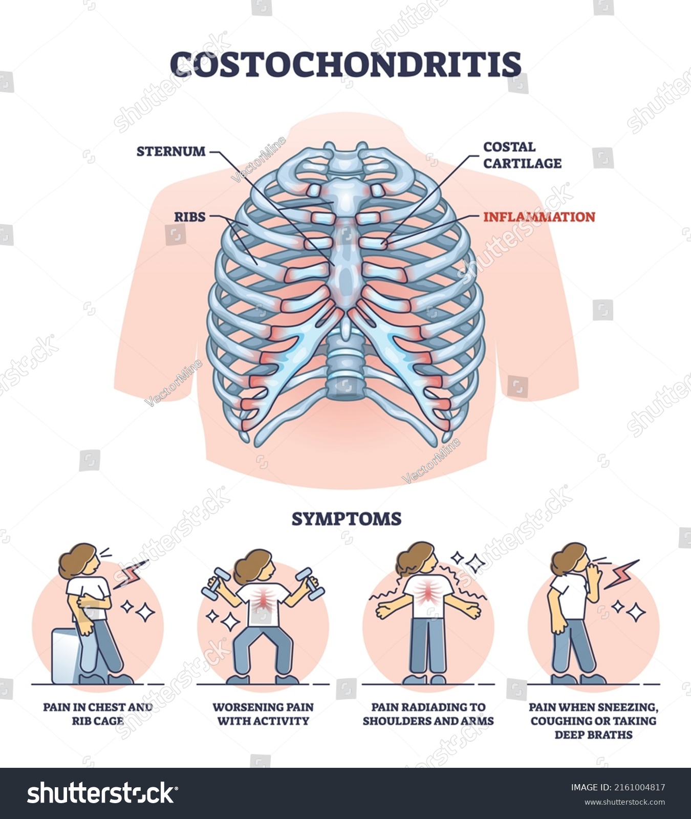 Costochondritis Chest Wall Pain Costosternal Syndrome Stock Vector