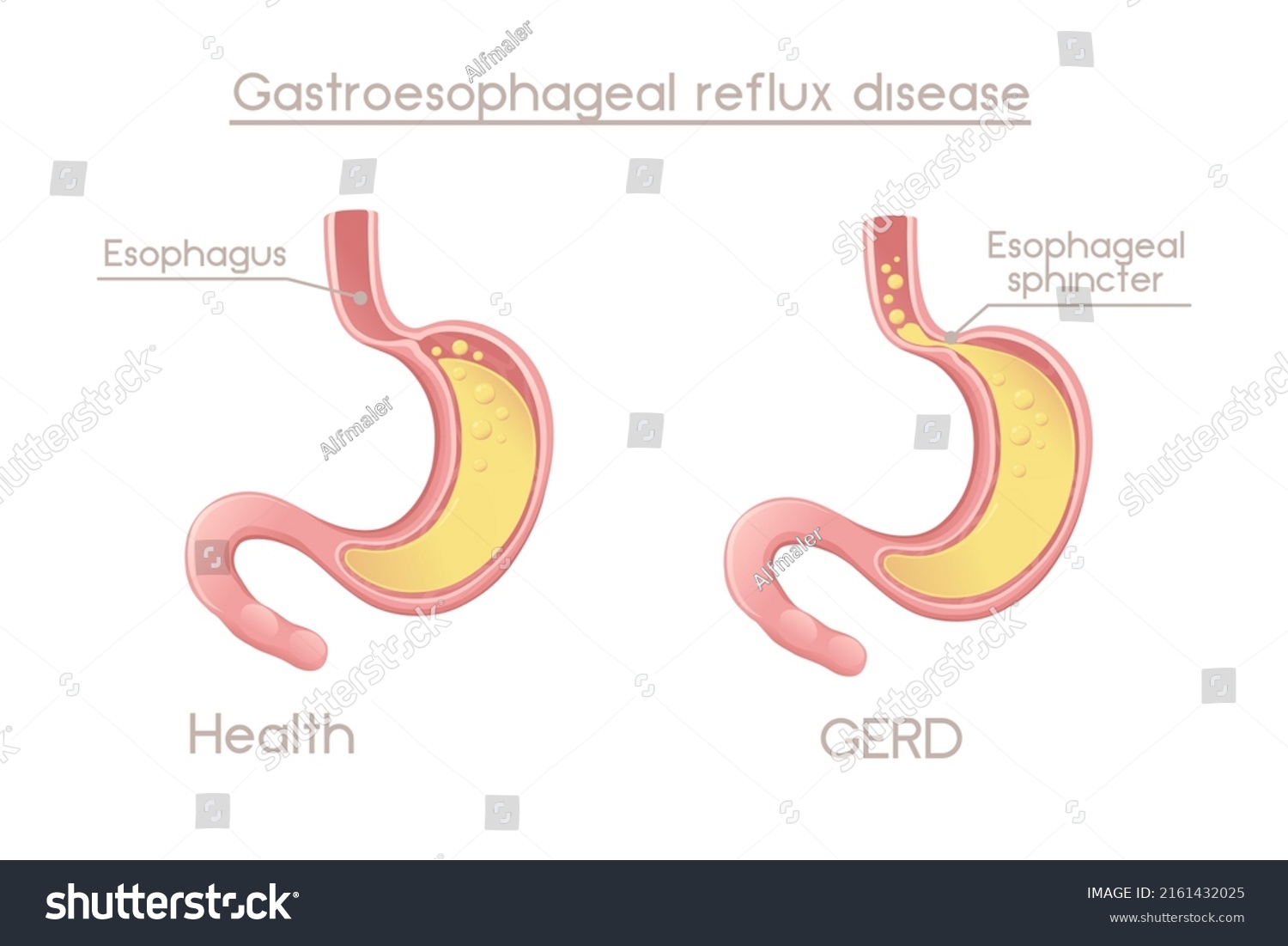 Human Stomach Gastroesophageal Reflux Disease Cartoon Stock Vector ...